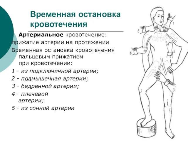 Временная остановка кровотечения Артериальное кровотечение: прижатие артерии на протяжении Временная остановка кровотечения