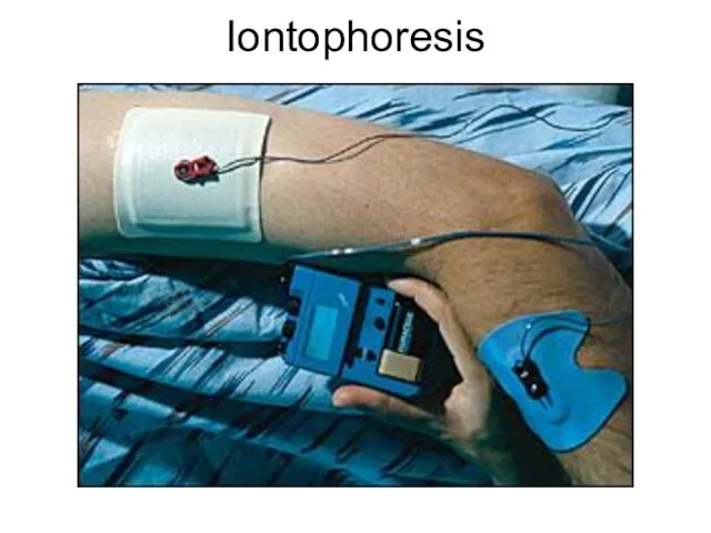 Iontophoresis