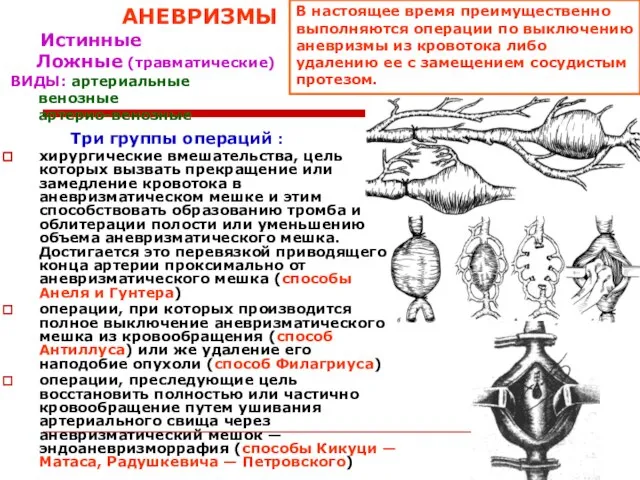 АНЕВРИЗМЫ Истинные Ложные (травматические) ВИДЫ: артериальные венозные артерио-венозные Три группы операций :