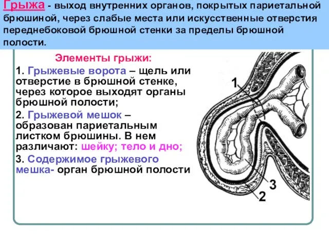 Грыжа - выход внутренних органов, покрытых париетальной брюшиной, через слабые места или