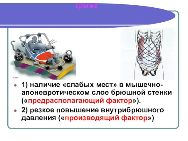 Факторы, способствующие возникновению грыж: 1) наличие «слабых мест» в мышечно-апоневротическом слое брюшной