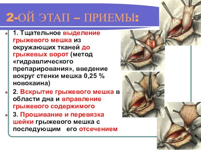 2-ОЙ ЭТАП – ПРИЕМЫ: 1. Тщательное выделение грыжевого мешка из окружающих тканей