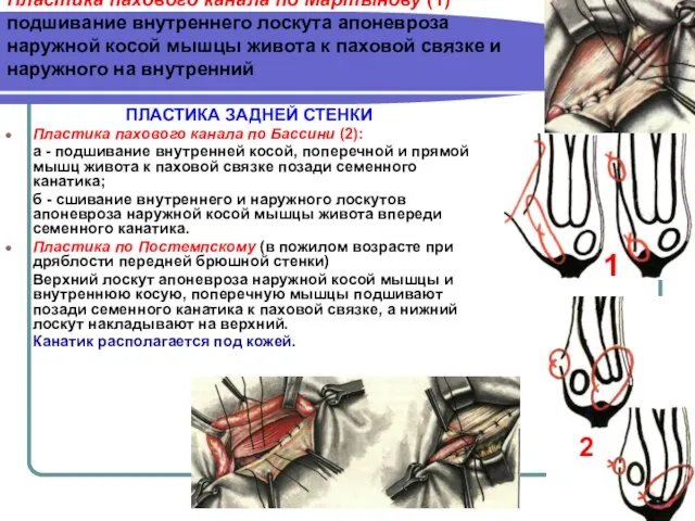 Пластика пахового канала по Мартынову (1) подшивание внутреннего лоскута апоневроза наружной косой