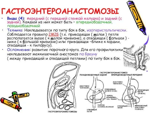 ГАСТРОЭНТЕРОАНАСТОМОЗЫ Виды (4): передний (с передней стенкой желудка) и задний (с задней).