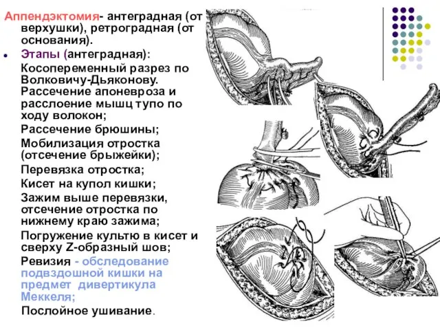 Аппендэктомия- антеградная (от верхушки), ретроградная (от основания). Этапы (антеградная): Косопеременный разрез по