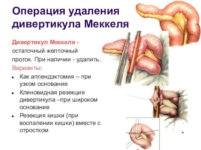 Операция удаления дивертикула Меккеля Дивертикул Меккеля - остаточный желточный проток. При наличии