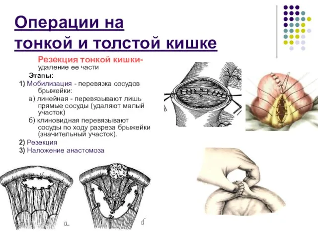 Операции на тонкой и толстой кишке Резекция тонкой кишки- удаление ее части