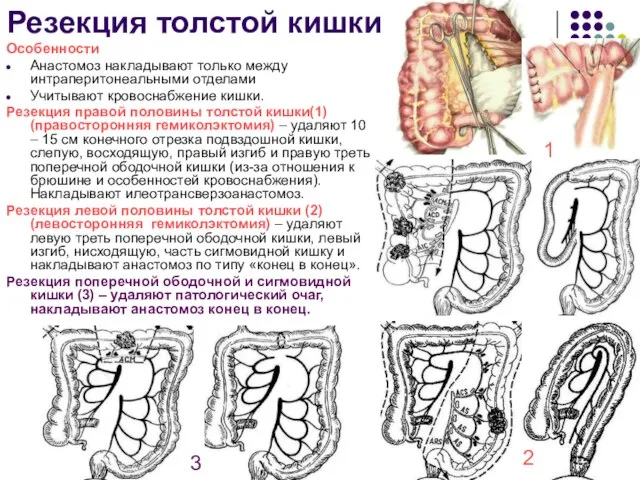 Резекция толстой кишки Особенности Анастомоз накладывают только между интраперитонеальными отделами Учитывают кровоснабжение