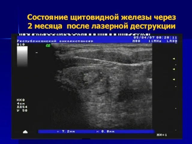 Состояние щитовидной железы через 2 месяца после лазерной деструкции