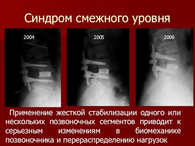 Синдром смежного уровня Применение жесткой стабилизации одного или нескольких позвоночных сегментов приводит