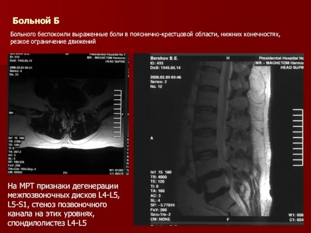 Больной Б Больного беспокоили выраженные боли в пояснично-крестцовой области, нижних конечностях, резкое