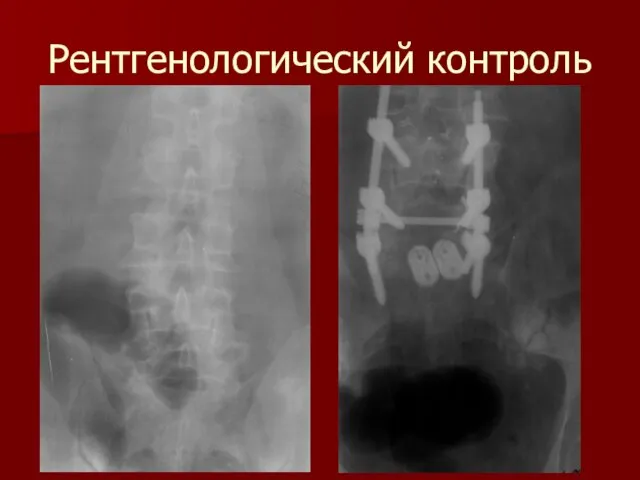 Рентгенологический контроль