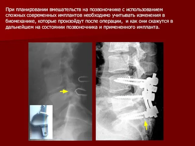 При планировании вмешательств на позвоночнике с использованием сложных современных имплантов необходимо учитывать