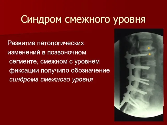 Синдром смежного уровня Развитие патологических изменений в позвоночном сегменте, смежном с уровнем