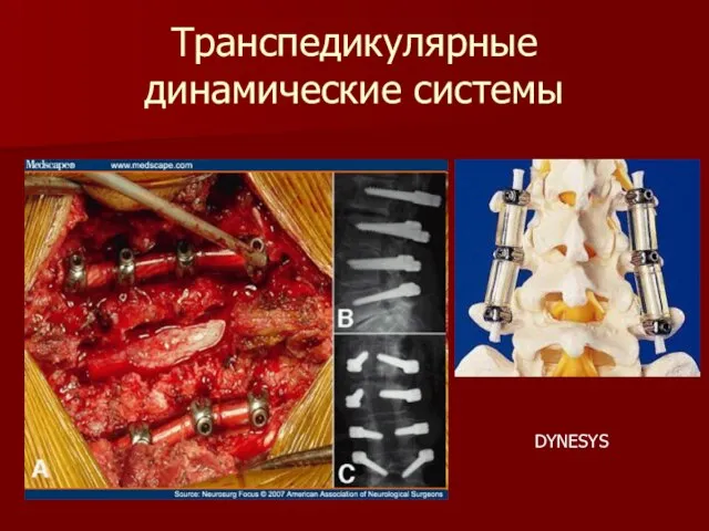 Транспедикулярные динамические системы DYNESYS