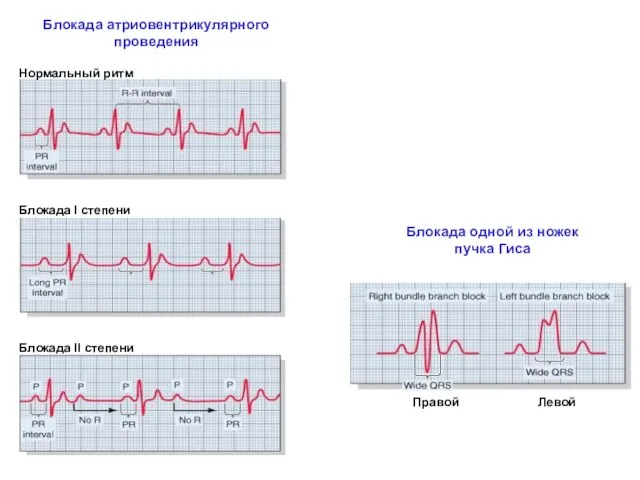 Блокада атриовентрикулярного проведения Нормальный ритм Блокада I степени Блокада II степени Блокада