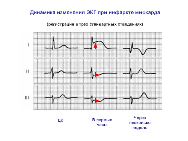 Динамика изменения ЭКГ при инфаркте миокарда (регистрация в трех стандартных отведениях) До