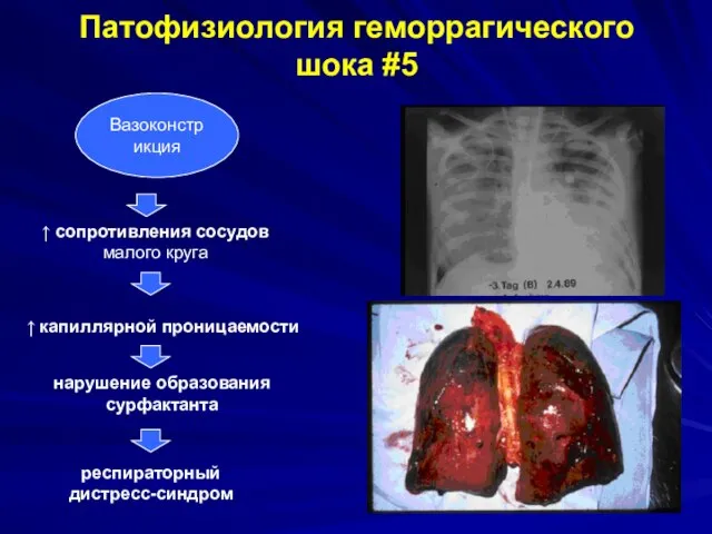 Вазоконстрикция ↑ сопротивления сосудов малого круга ↑ капиллярной проницаемости нарушение образования сурфактанта