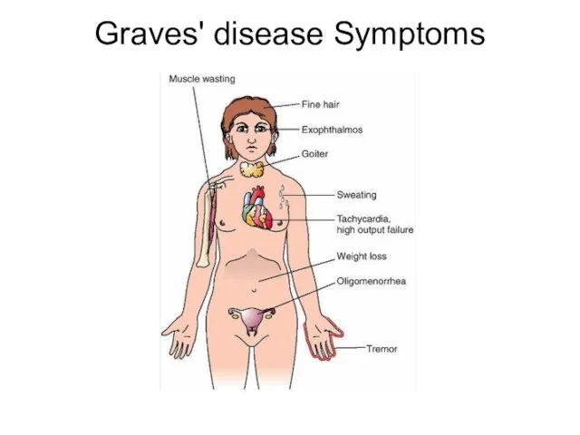 Graves' disease Symptoms