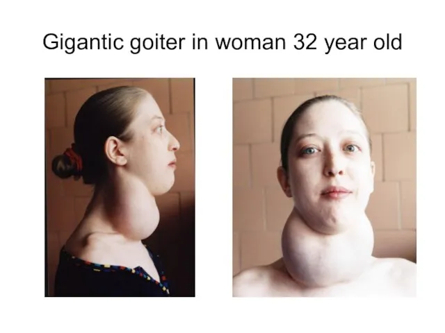 Gigantic goiter in woman 32 year old