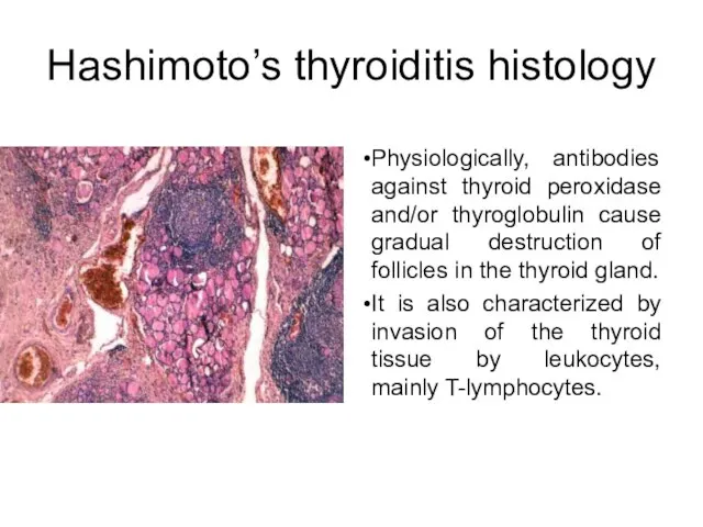 Hashimoto’s thyroiditis histology Physiologically, antibodies against thyroid peroxidase and/or thyroglobulin cause gradual