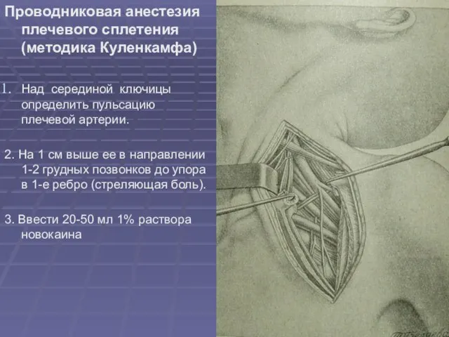 Проводниковая анестезия плечевого сплетения (методика Куленкамфа) Над серединой ключицы определить пульсацию плечевой