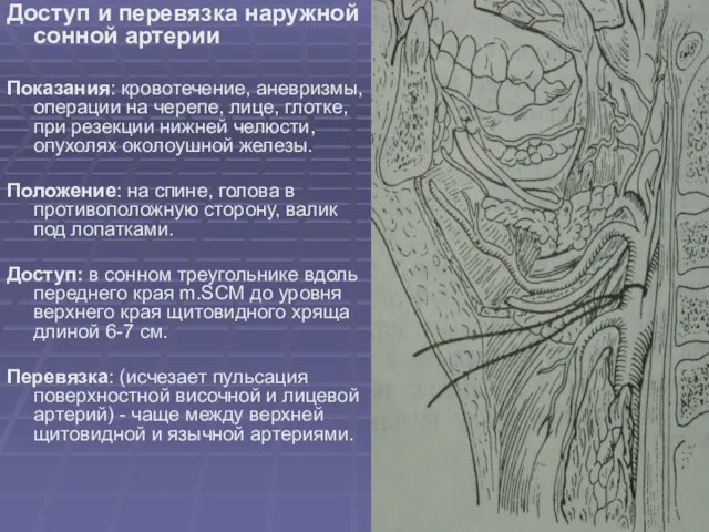 Доступ и перевязка наружной сонной артерии Показания: кровотечение, аневризмы, операции на черепе,