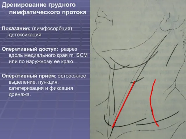 Дренирование грудного лимфатического протока Показания: (лимфосорбция) детоксикация Оперативный доступ: разрез вдоль медиального