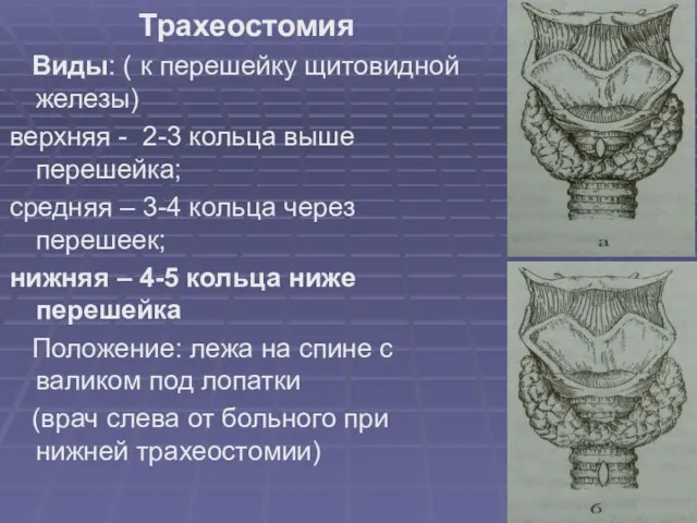 Трахеостомия Виды: ( к перешейку щитовидной железы) верхняя - 2-3 кольца выше