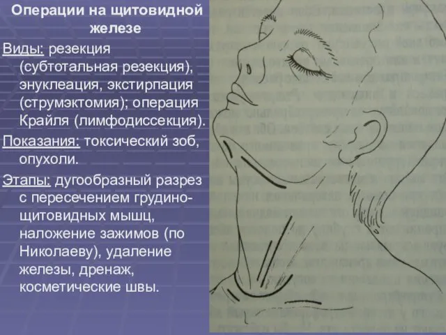 Операции на щитовидной железе Виды: резекция (субтотальная резекция), энуклеация, экстирпация (струмэктомия); операция