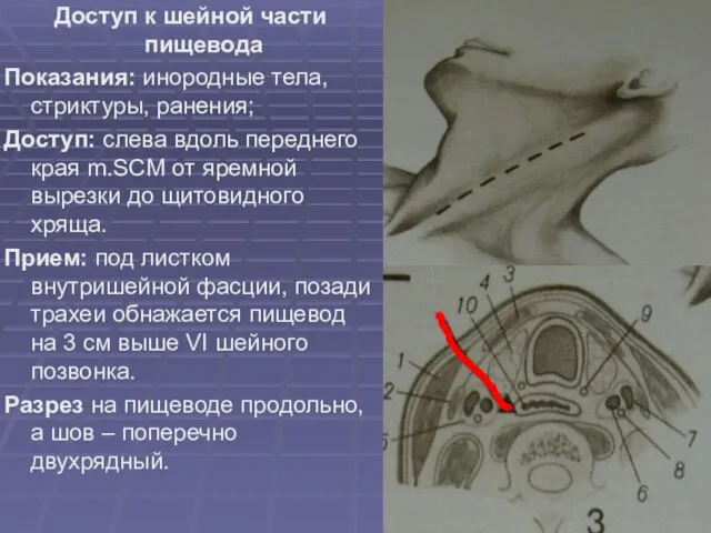 Доступ к шейной части пищевода Показания: инородные тела, стриктуры, ранения; Доступ: слева