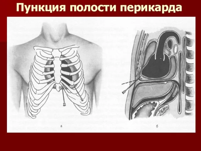 Пункция полости перикарда