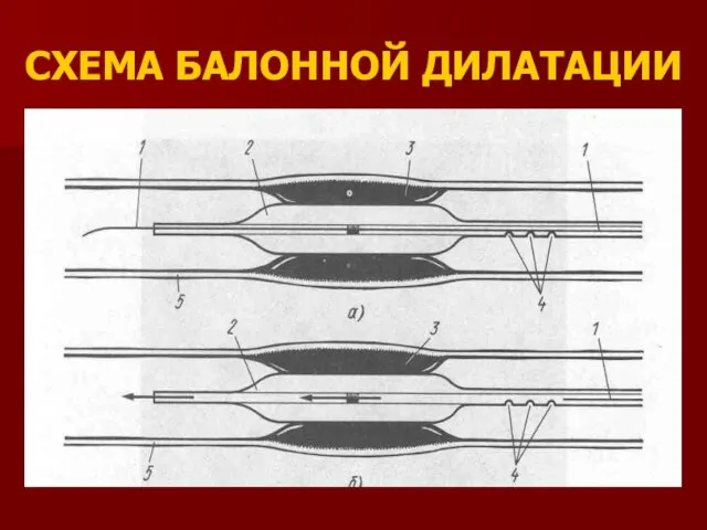 СХЕМА БАЛОННОЙ ДИЛАТАЦИИ