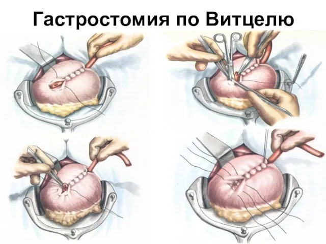 Гастростомия по Витцелю