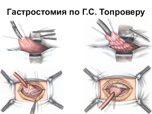 Гастростомия по Г.С. Топроверу