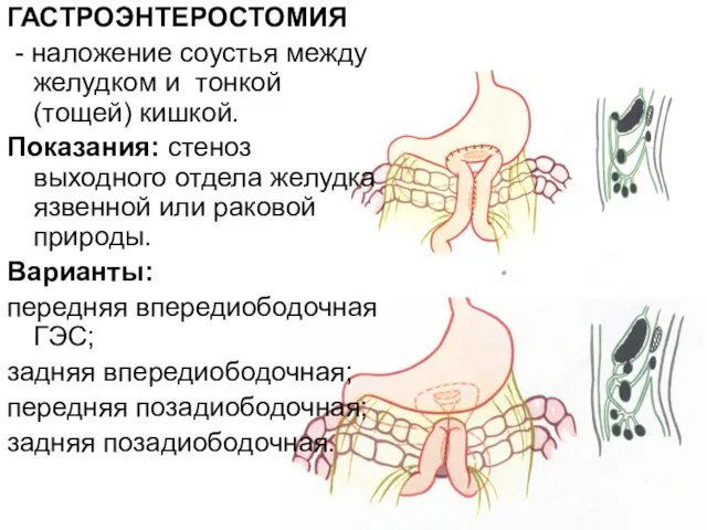 ГАСТРОЭНТЕРОСТОМИЯ - наложение соустья между желудком и тонкой (тощей) кишкой. Показания: стеноз