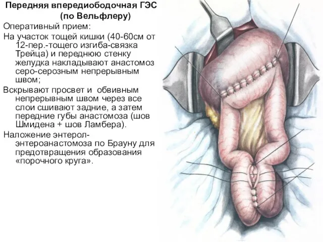 Передняя впередиободочная ГЭС (по Вельфлеру) Оперативный прием: На участок тощей кишки (40-60см