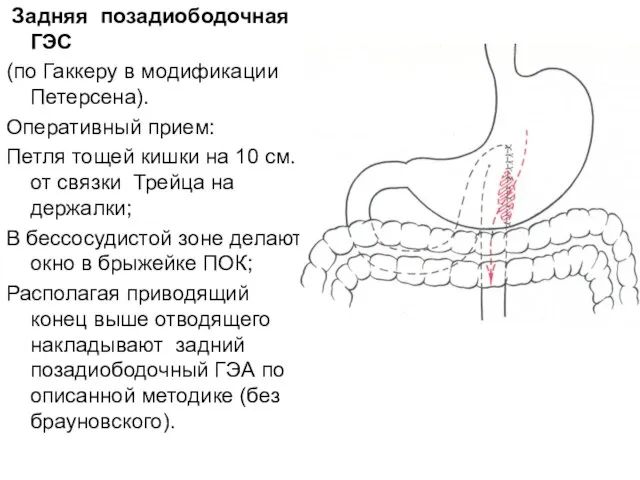 Задняя позадиободочная ГЭС (по Гаккеру в модификации Петерсена). Оперативный прием: Петля тощей