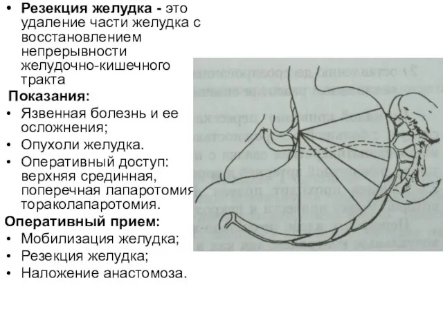 Резекция желудка - это удаление части желудка с восстановлением непрерывности желудочно-кишечного тракта