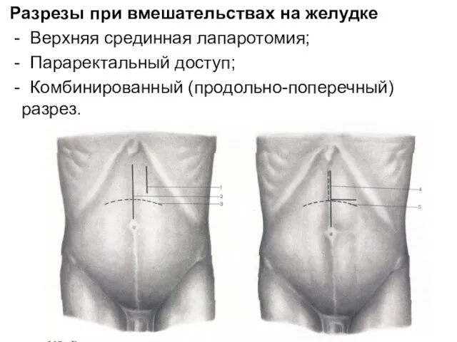 Разрезы при вмешательствах на желудке - Верхняя срединная лапаротомия; - Параректальный доступ; - Комбинированный (продольно-поперечный) разрез.