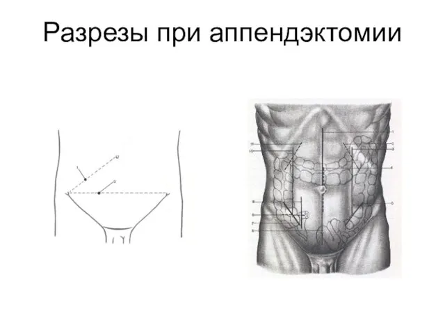 Разрезы при аппендэктомии