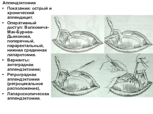 Аппендэктомия Показания: острый и хронический аппендицит. Оперативный доступ: Волковича-Мак-Бурнея-Дьяконова, поперечный, параректальный, нижняя