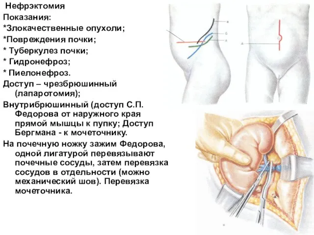 Нефрэктомия Показания: *Злокачественные опухоли; *Повреждения почки; * Туберкулез почки; * Гидронефроз; *