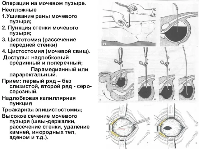 Операции на мочевом пузыре. Неотложные 1.Ушивание раны мочевого пузыря; 2. Пункция стенки