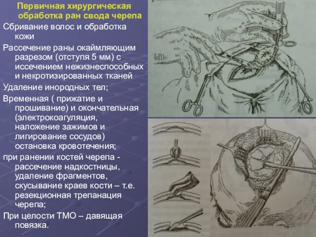 Первичная хирургическая обработка ран свода черепа Сбривание волос и обработка кожи Рассечение