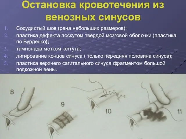 Остановка кровотечения из венозных синусов Сосудистый шов (рана небольших размеров); пластика дефекта