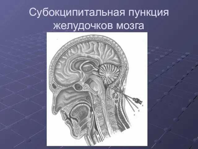 Субокципитальная пункция желудочков мозга