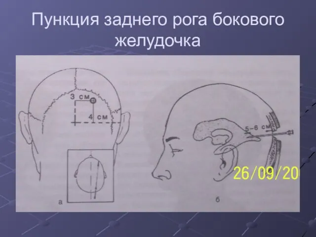 Пункция заднего рога бокового желудочка