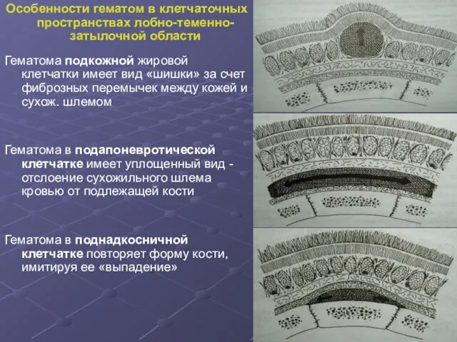 Особенности гематом в клетчаточных пространствах лобно-теменно-затылочной области Гематома подкожной жировой клетчатки имеет