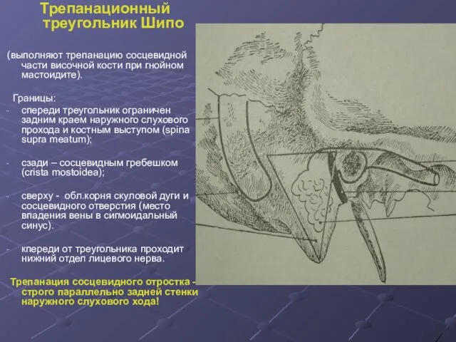 Трепанационный треугольник Шипо (выполняют трепанацию сосцевидной части височной кости при гнойном мастоидите).